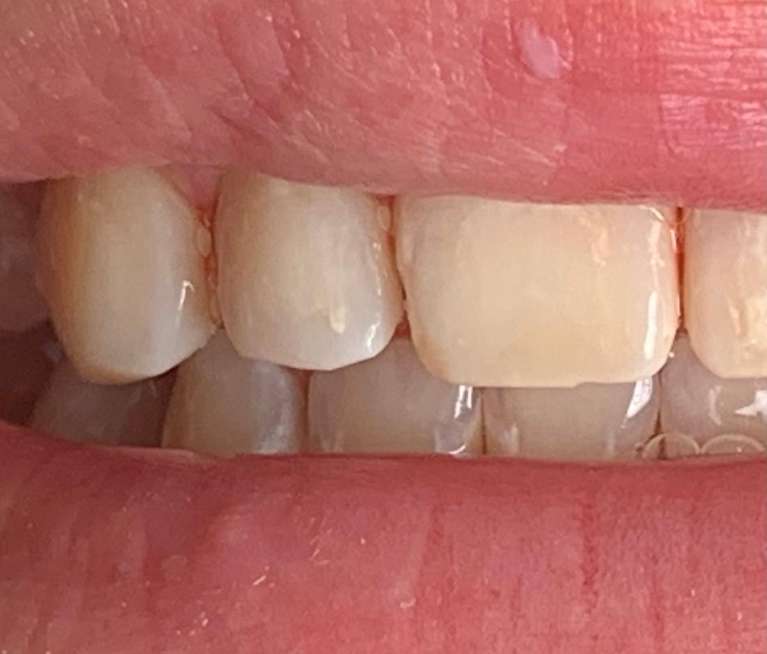 Resin-Infiltration-After-Image