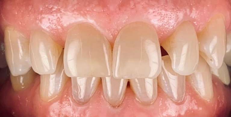 Smile-Make-Over-Using-Digitally-Designed-Smiles-Before-Image